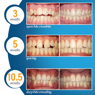 Propel - Orthodontic Treatment Aid | UBC Dentist